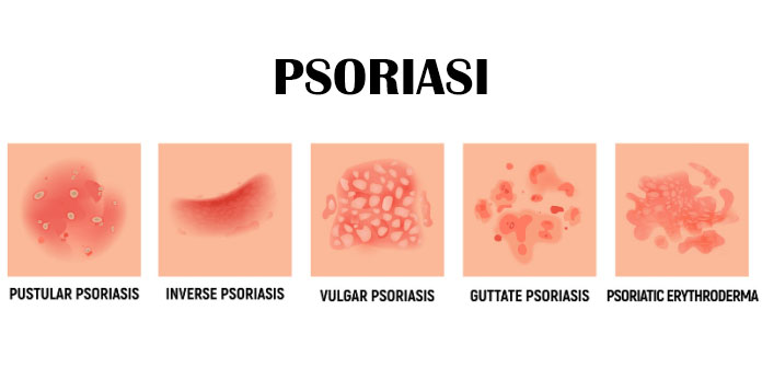 Psoriasi