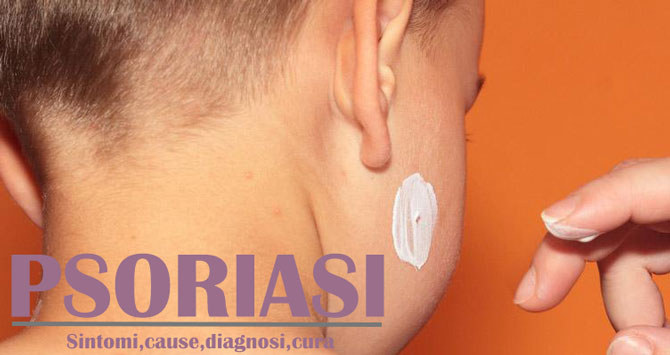 Psoriasi