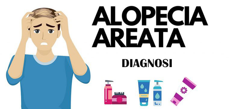 alopecia areata