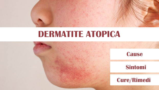 dermatite atopica 1 2